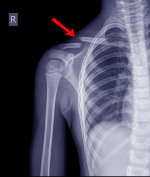 fractura-clavicula