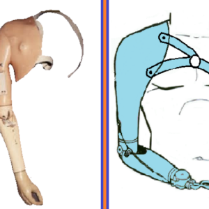 PROTESIS DESARTICULADO DE HOMBRO