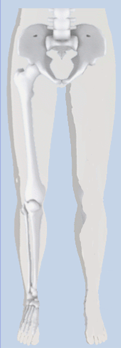 protesis-inferior-desarticulado-de-cadera