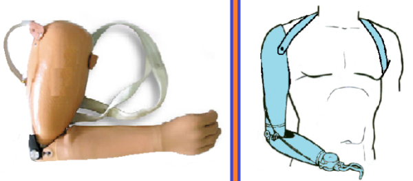 PROTESIS TRANHUMERAL