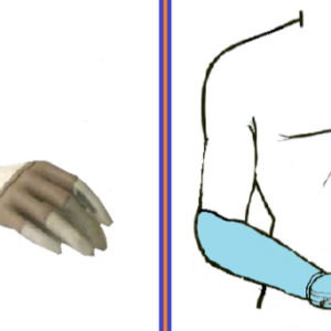 PROTESIS TRASRADIAL