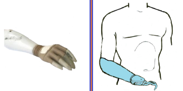 PROTESIS TRASRADIAL